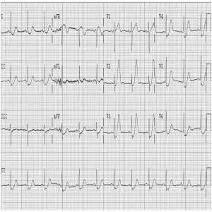 STEMI equiv 2 de-Winters-T-Waves